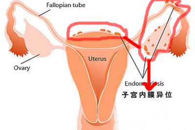 子宫内膜异位症