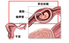 孕妈妈若现腹部疼痛 当心输卵管妊娠