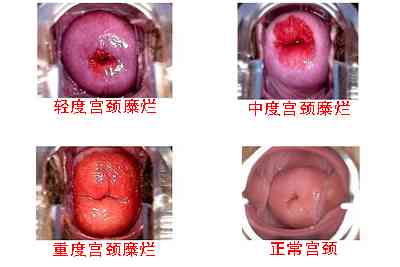 宫颈糜烂