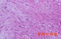 右腿肿物长到柚子般大小 原来是得了神经纤维瘤