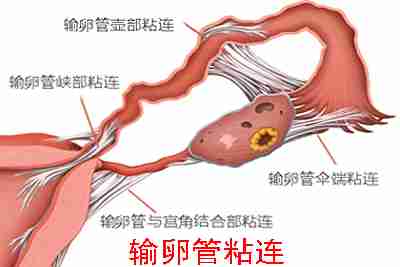 输卵管粘连