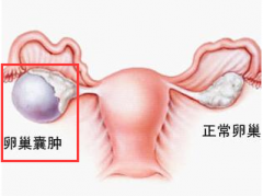 肚大像吹满气的气球 原是巨大卵巢囊肿