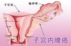子宫内膜癌钟爱四类女性 若现阴道出血要留心