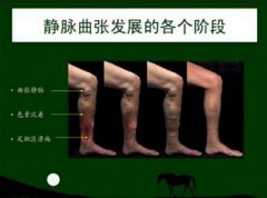 腿部血管团状凸起  小心静脉曲张悄悄来袭