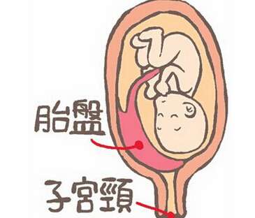 胎盘早剥
