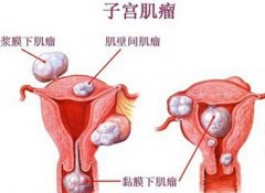 腹部隆起异常如怀孕8个月 原来是子宫肌瘤