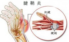 长时间埋头涂色 女子腱鞘炎复发