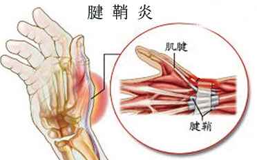 腱鞘炎