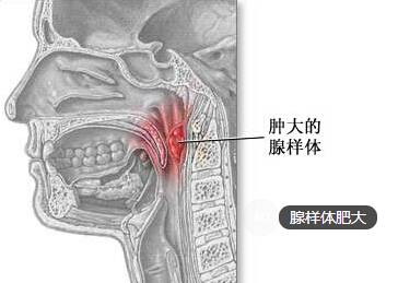 腺样体肥大