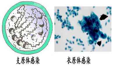 支原体衣原体感染