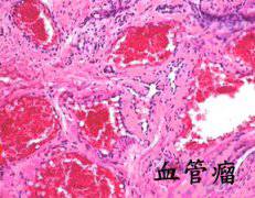 宝宝脸上长斑块勿忽视  当心血管瘤侵袭