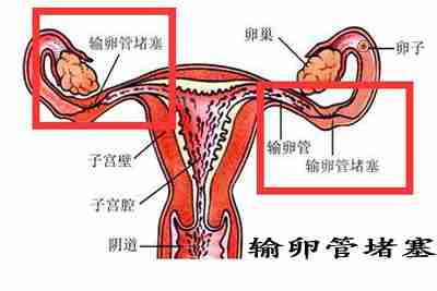 输卵管堵塞