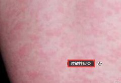 若现皮肤瘙痒红肿状 警惕过敏性皮炎