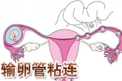 输卵管粘连不通 吃妇炎丸也能怀孕