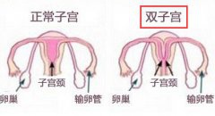 女子经期腹痛难耐 或患罕见双子宫症