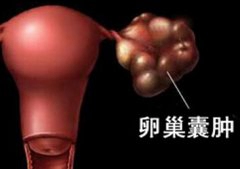 因卵巢囊肿出现扭转 她竟然晕倒