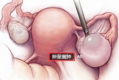 腹痛到不能让人触碰 原是卵巢囊肿作怪