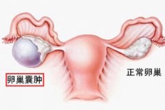 怀孕做孕检 B超发现胎儿和卵巢囊肿并存