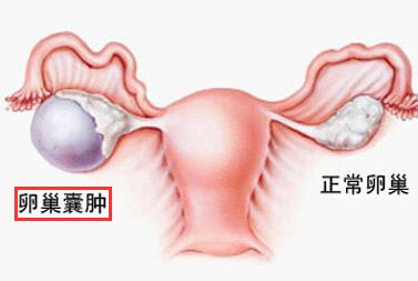 卵巢囊肿