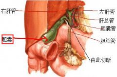 爱吃鸡蛋的她 吃出胆囊结石还是多发结石