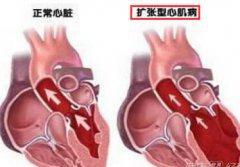 打球后喘气还双腿肿 检查是扩张性心肌病