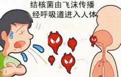 流产后反复发热 原来是肺结核作祟