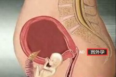 哺乳期腹痛厉害 原是宫外孕大出血