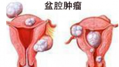 60岁还不绝经  竟然是盆腔肿瘤所致