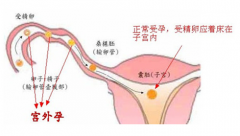 若现下腹坠痛、停经状 或是宫外孕所致