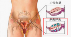 “女汉子”更需警惕多囊卵巢综合征