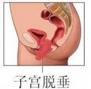 预防子宫脱垂 要从年轻时做起