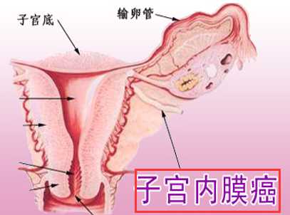 子宫内膜癌