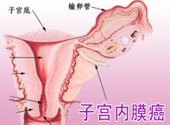 更年期吃三年保健品 吃出子宫内膜癌