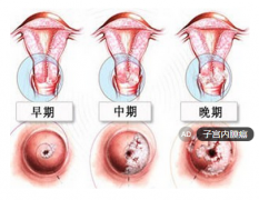 绝经后阴道出血反复 小心子宫内膜癌前病