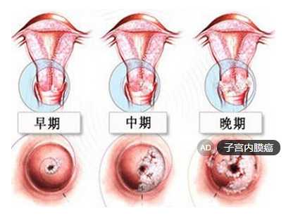 子宫内膜癌