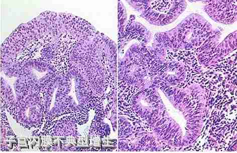 子宫内膜不典型增生