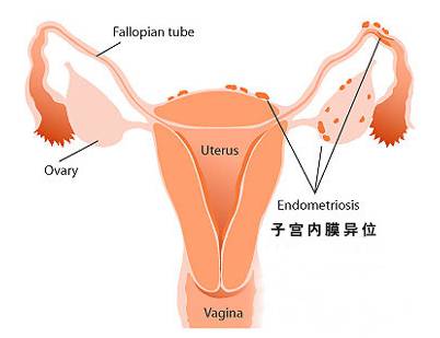 子宫内膜异位症