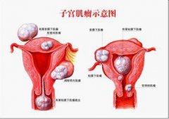 痛经?那你患子宫肌瘤概率高达95%