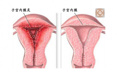 子宫内膜炎引发的腹痛如何缓解