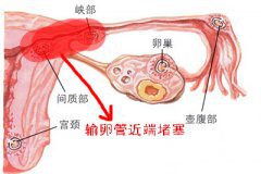 预防不孕：输卵管问题所致不孕有哪些？