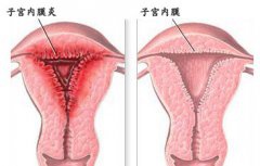 警惕经期腹痛，可能是子宫内膜炎的主要症状