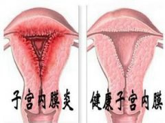 中药治疗子宫内膜炎是否更理想