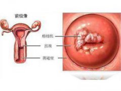 宫颈炎会有哪些症状？得了宫颈炎的注意事项