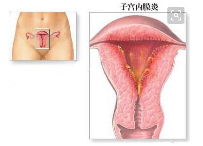 子宫内膜炎病因