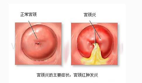 宫颈炎的早期症状