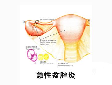 妇炎丸治疗盆腔炎