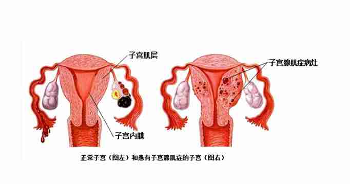 妇炎丸治疗子宫腺肌症