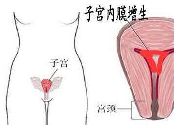 妇炎丸治疗子宫内膜增生