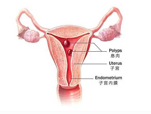 妇炎丸治疗子宫内膜息肉