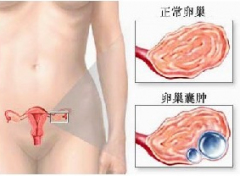 卵巢囊肿切了就万事大吉吗？看这个你就全明白